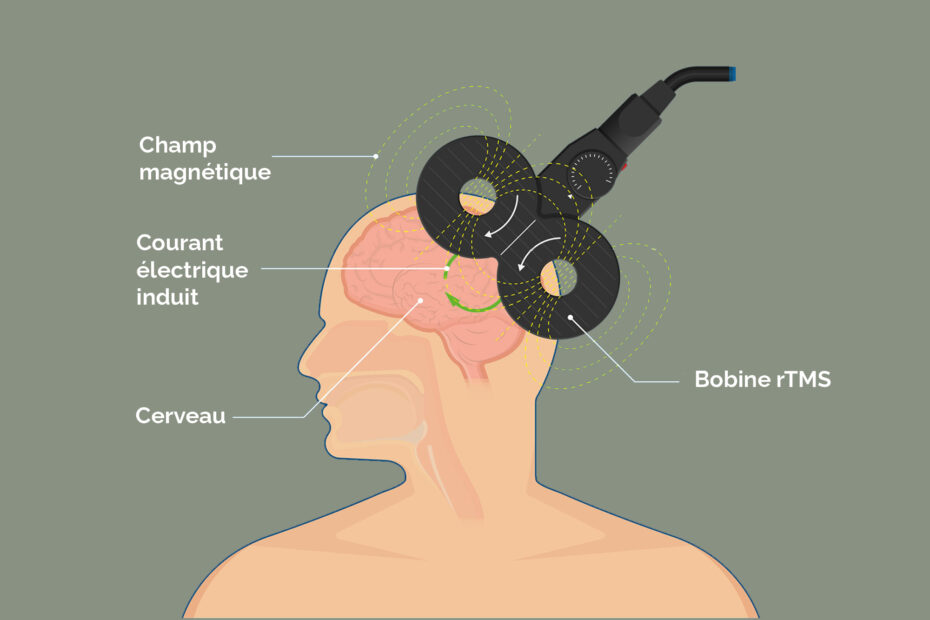 Illustration rTMS